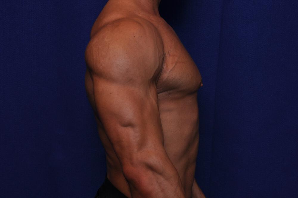 Bodybuilder Gynecomastia Gallery Before & After Image