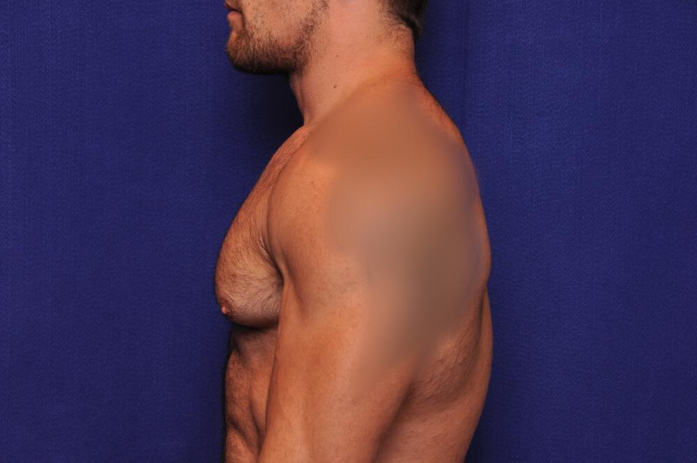 Bodybuilder Gynecomastia Gallery Before & After Image