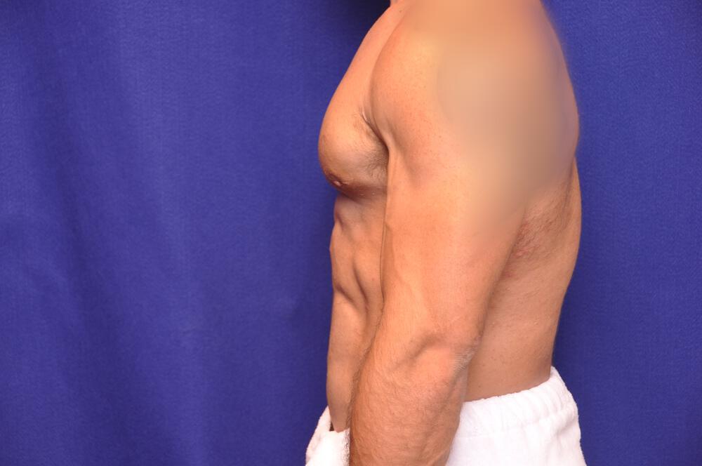 Bodybuilder Gynecomastia Gallery Before & After Image