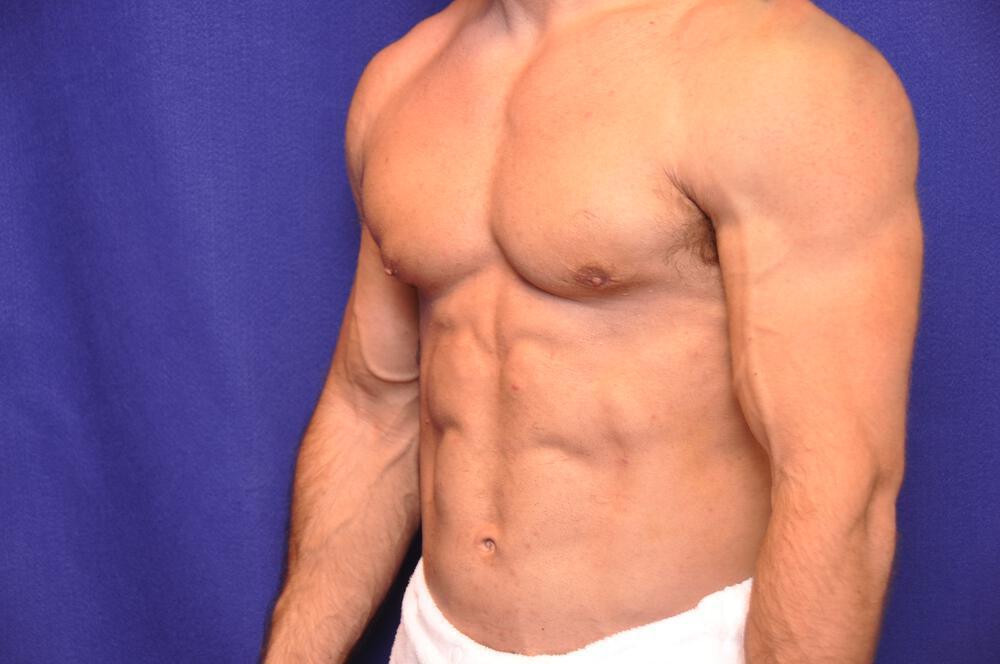 Bodybuilder Gynecomastia Gallery Before & After Image