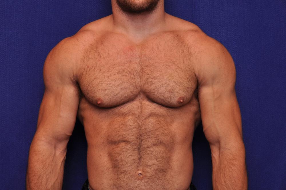 Bodybuilder Gynecomastia Gallery Before & After Image