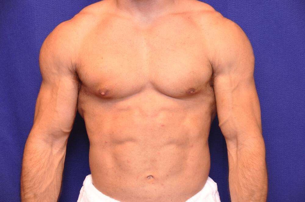 Bodybuilder Gynecomastia Gallery Before & After Image