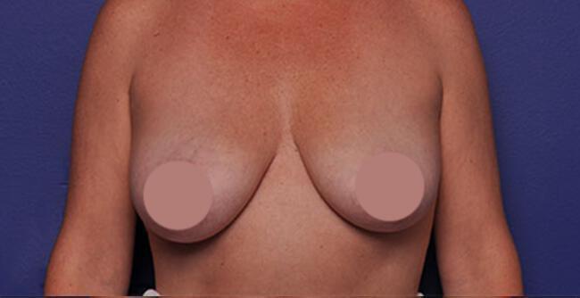 Breast Augmentation Gallery Before & After Image