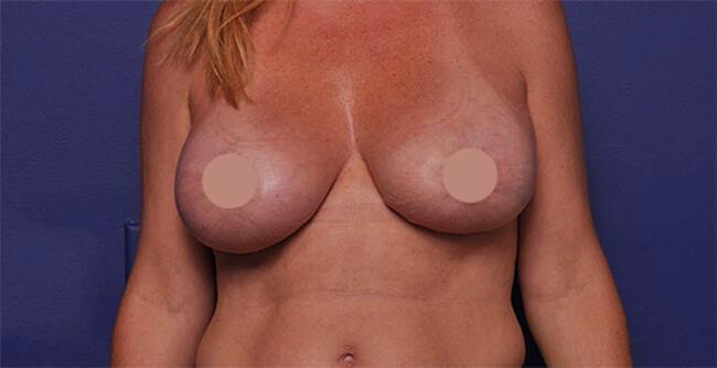 Breast Augmentation Gallery Before & After Image