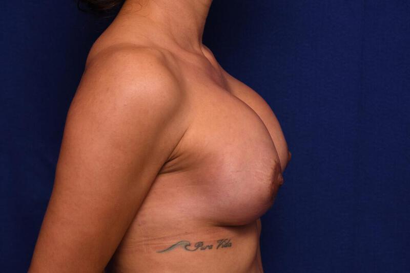 Breast Augmentation Gallery Before & After Image