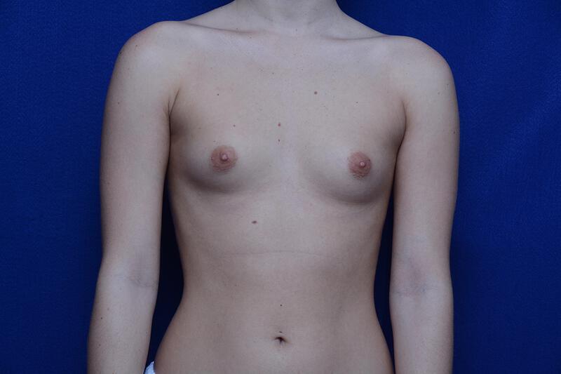 Breast Augmentation Gallery Before & After Image