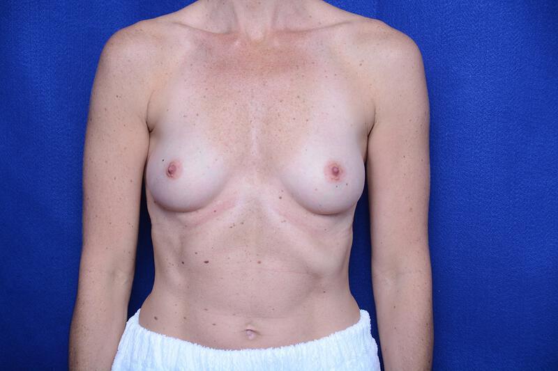 Breast Augmentation Gallery Before & After Image