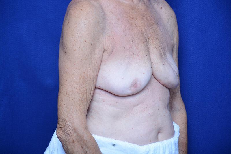 Breast Augmentation Gallery Before & After Image