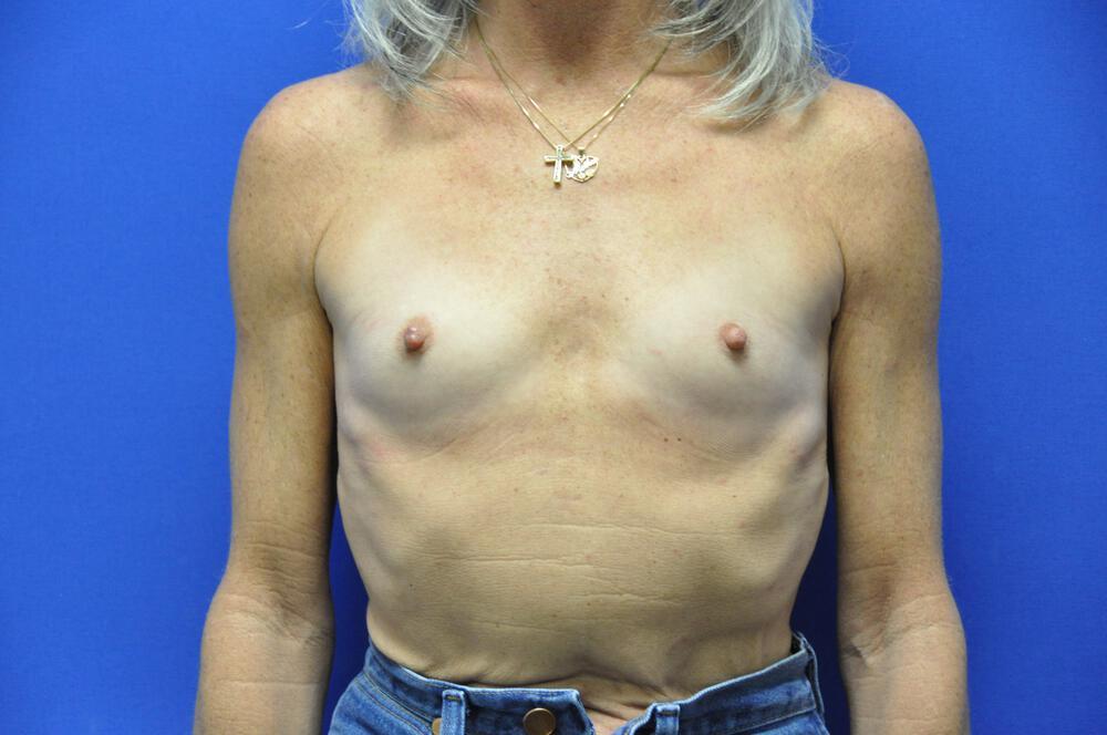 Breast Augmentation Gallery Before & After Image