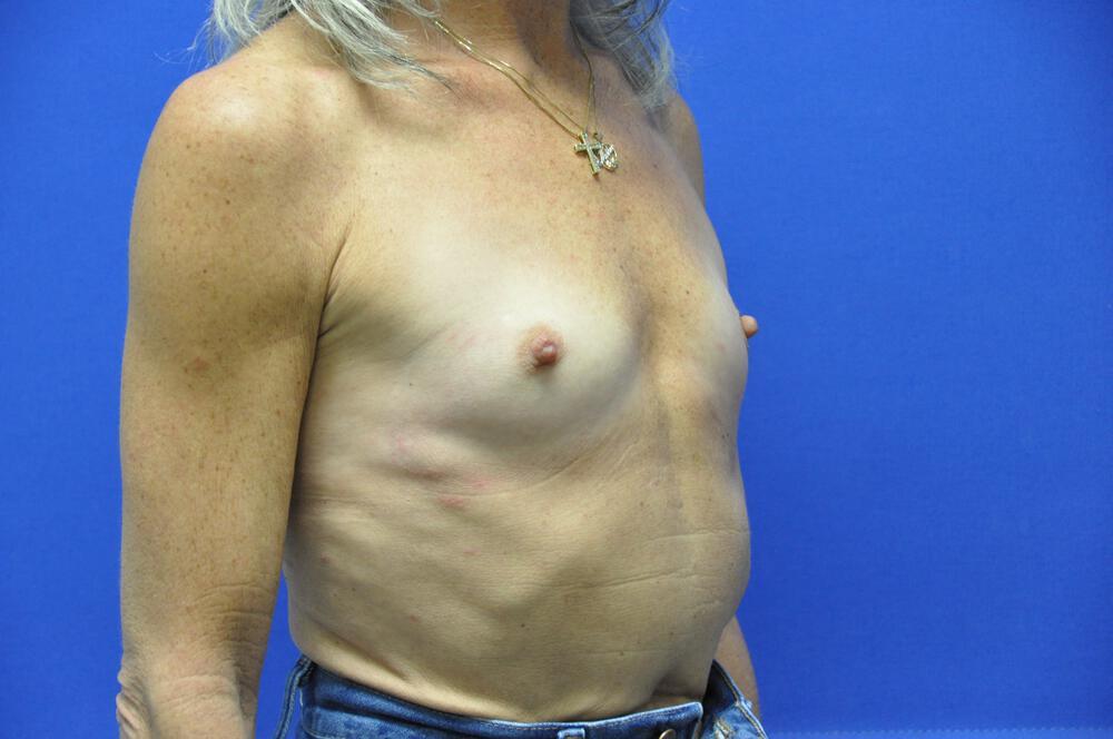 Breast Augmentation Gallery Before & After Image