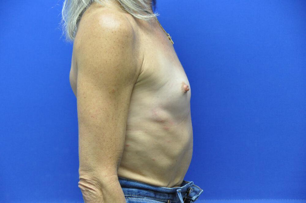 Breast Augmentation Gallery Before & After Image