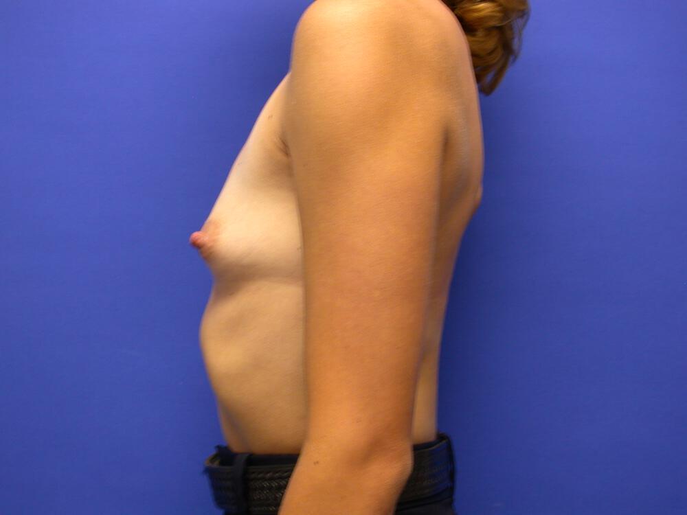 Breast Augmentation Gallery Before & After Image