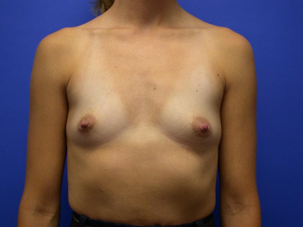 Breast Augmentation Gallery Before & After Image