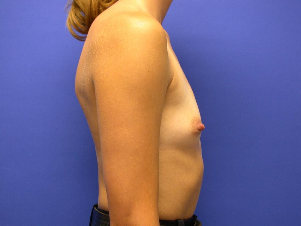 Breast Augmentation Gallery Before & After Image