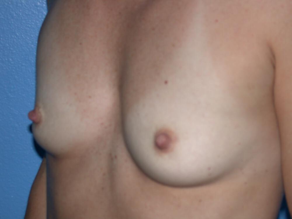 Breast Augmentation Gallery Before & After Image