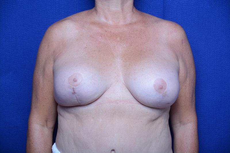 Breast Implant Removal Gallery Before & After Image