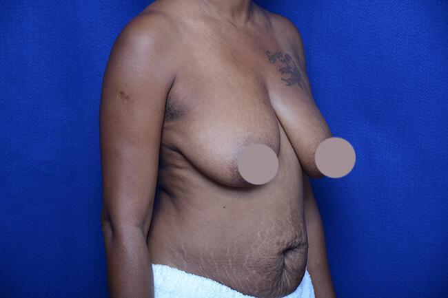 Breast Lift With Augmentation Gallery Before & After Image