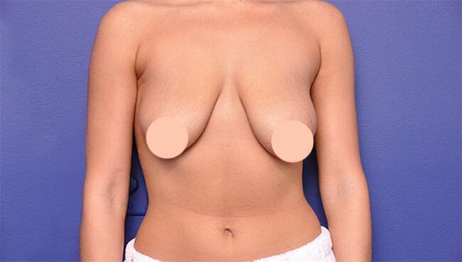 Breast Lift With Augmentation Gallery Before & After Image