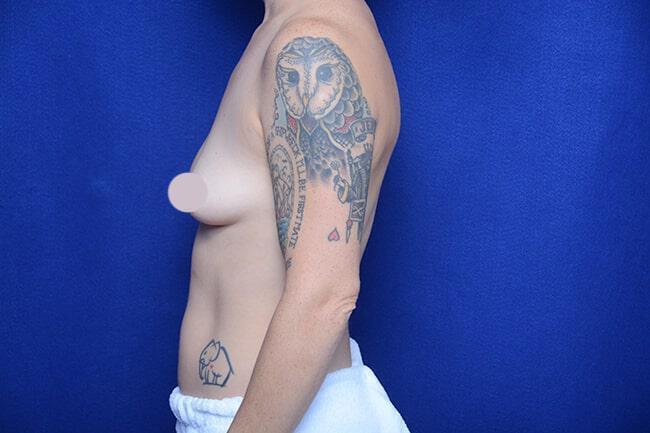 Breast Lift With Augmentation Gallery Before & After Image