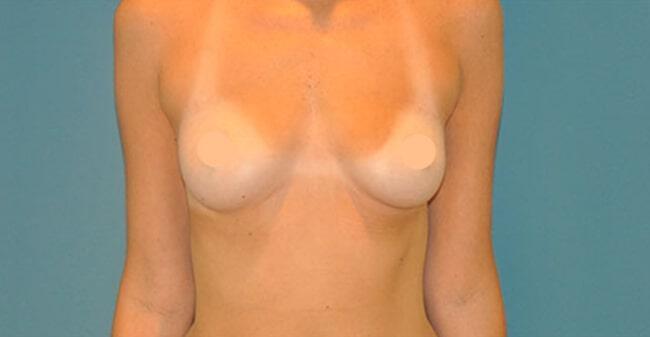 Breast Lift With Augmentation Gallery Before & After Image