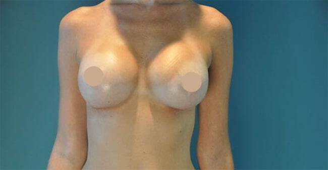 Breast Lift With Augmentation Gallery Before & After Image