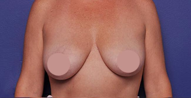 Breast Lift Gallery Before & After Image