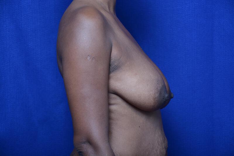 Breast Lift Gallery Before & After Image