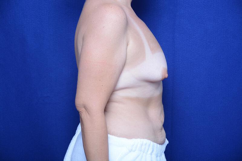 Breast Lift Gallery Before & After Image