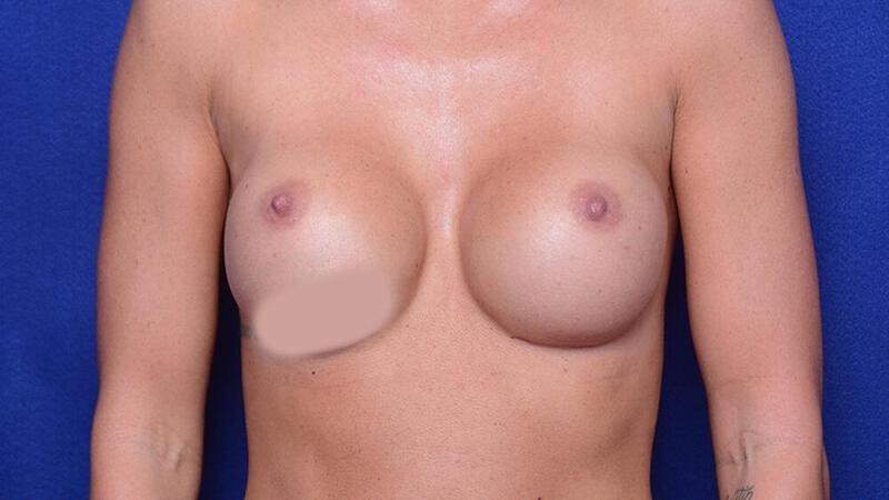Breast Revision Gallery Before & After Image