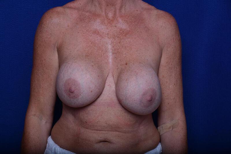 Breast Revision Gallery Before & After Image