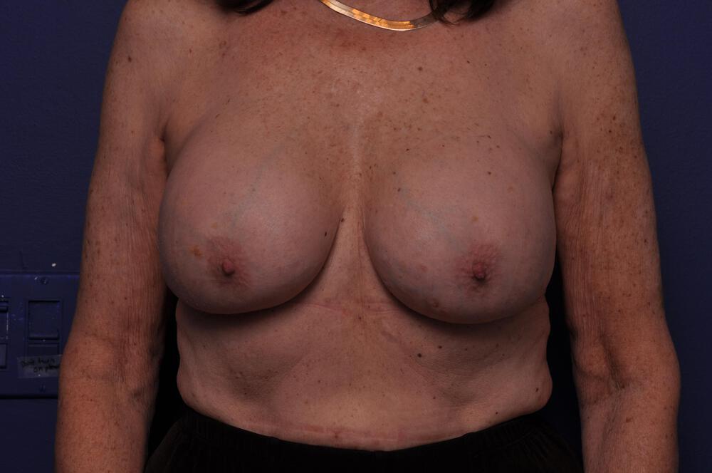 Breast Revision Gallery Before & After Image