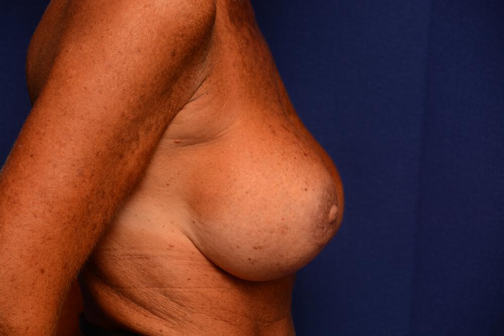 Breast Revision Gallery Before & After Image