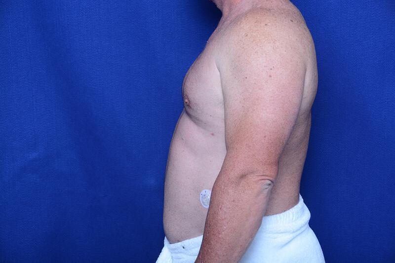 Gynecomastia Gallery Before & After Image