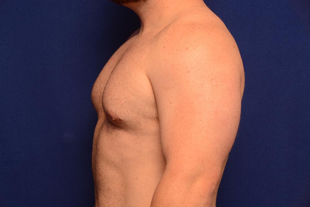 Gynecomastia Gallery Before & After Image