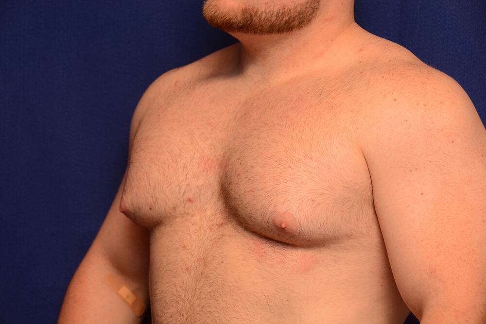 Gynecomastia Gallery Before & After Image