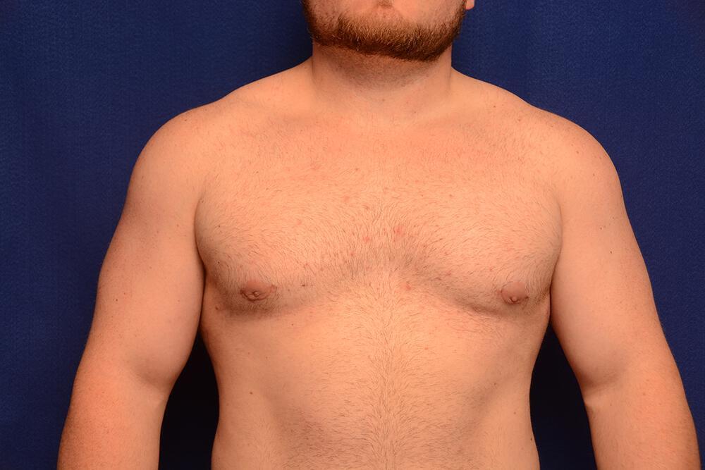 Gynecomastia Gallery Before & After Image