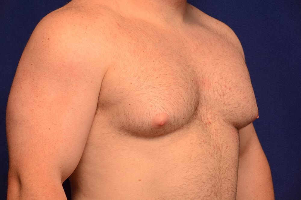 Gynecomastia Gallery Before & After Image