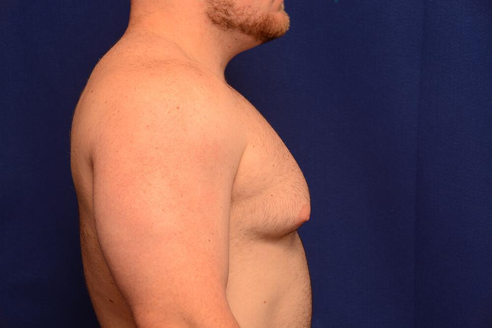 Gynecomastia Gallery Before & After Image