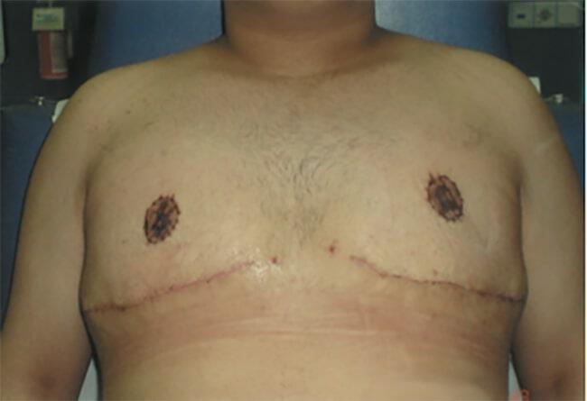 Gynecomastia Gallery Before & After Image