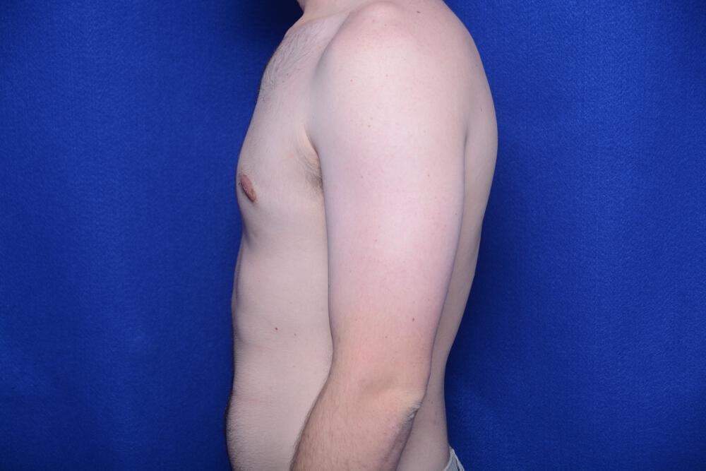 Gynecomastia Gallery Before & After Image