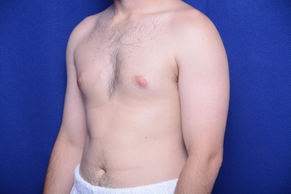 Gynecomastia Gallery Before & After Image