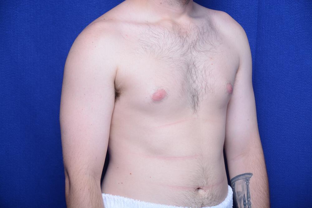 Gynecomastia Gallery Before & After Image