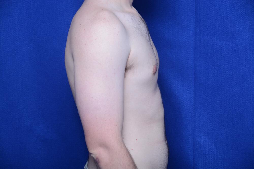 Gynecomastia Gallery Before & After Image