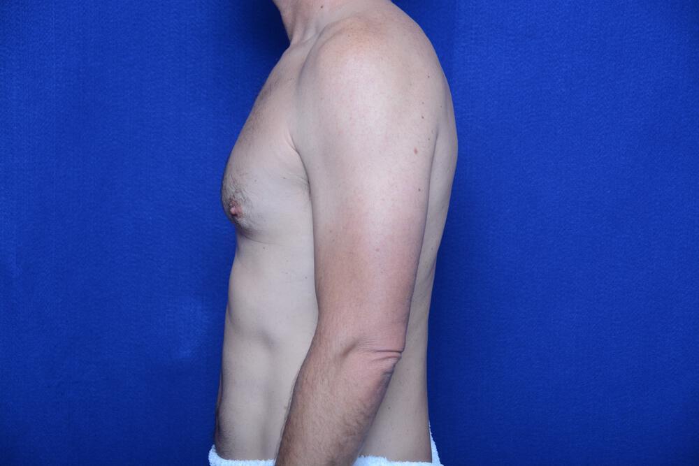 Gynecomastia Gallery Before & After Image