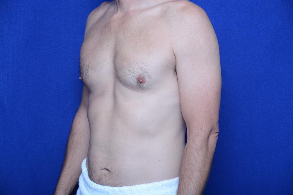 Gynecomastia Gallery Before & After Image