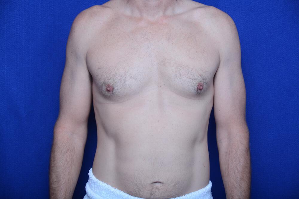 Gynecomastia Gallery Before & After Image