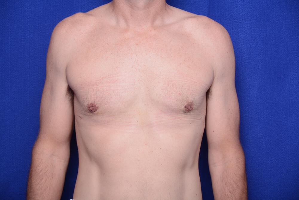 Gynecomastia Gallery Before & After Image