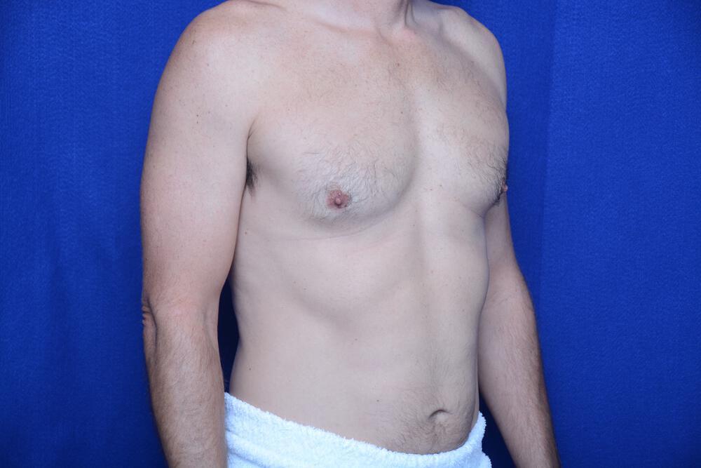 Gynecomastia Gallery Before & After Image