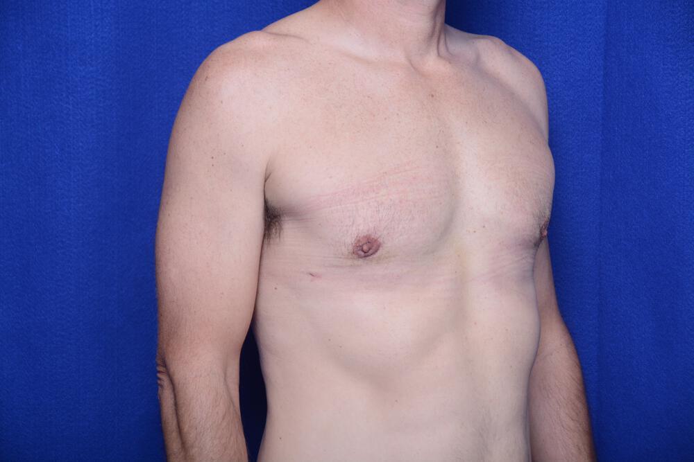 Gynecomastia Gallery Before & After Image