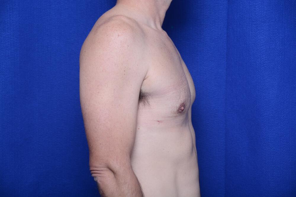 Gynecomastia Gallery Before & After Image